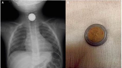 Cuerpos Extra Os Radiopacos Con Doble Contorno En La V A Digestiva