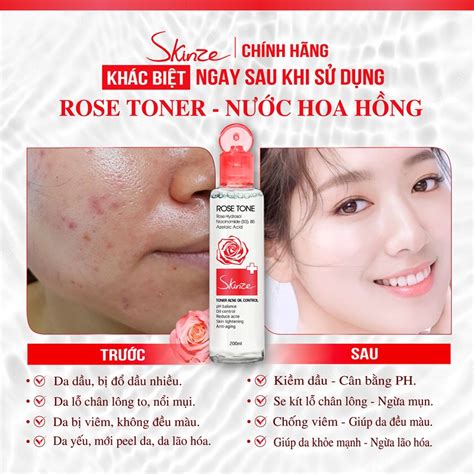 N C Hoa H Ng Toner Skinze Acne Oil Control Cho Da D U M N L M D U Da