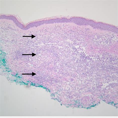 A 100x Image Of The Skin Biopsy With Hande Stain Showing A Normal Download Scientific Diagram