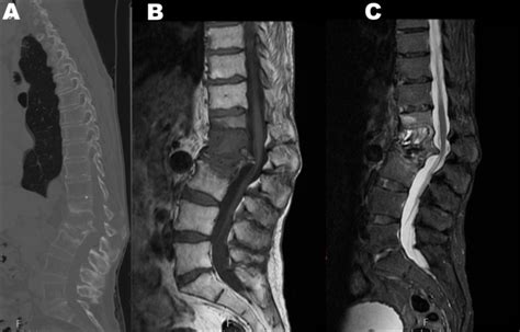 Pre Operative Ct And Mri Spine A Sagittal Ct Section Demonstrates Download Scientific Diagram