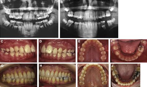 Multidisciplinary Management Of Permanent First Molar Extractions American Journal Of