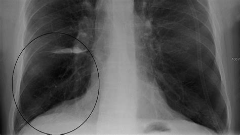 Chest X Ray Copd Lungs Vs Normal Lungs At Victor Lopez Blog