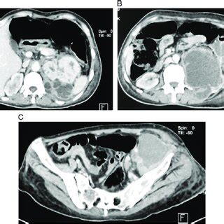 Contrast Enhanced Computed Tomography Scan Of The Abdomen And Pelvis