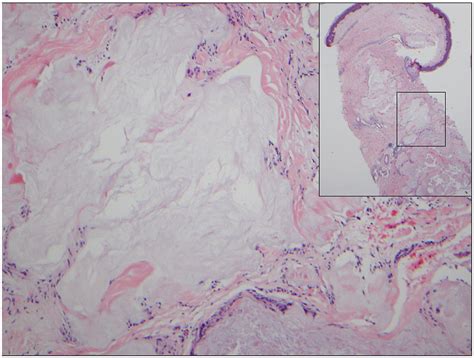 An Uncommon Presentation Of Cutaneous Dissemination Of Gout Jaad Case