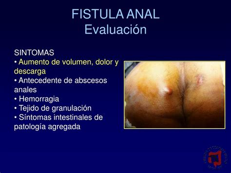 Ppt Conceptos Actuales En El Tratamiento De La Fistula Anal