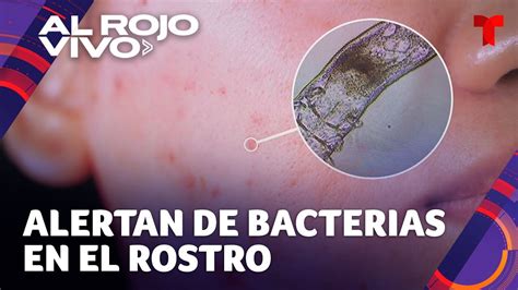 Alerta Por Bacterias En La Cara Que Podrían Afectar La Salud De La Piel