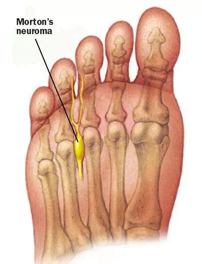 Morton S Neuroma Orchard Health Clinic Osteopathy Physiotherapy