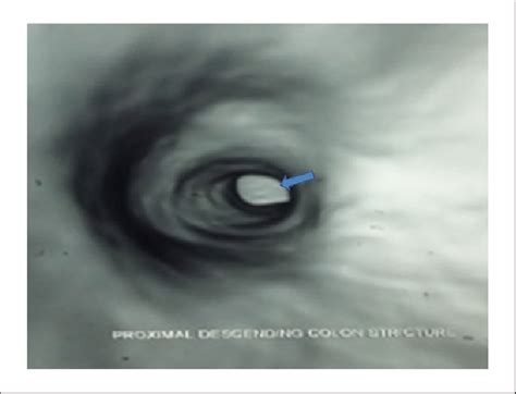 Computed Tomography Colonoscopy Revealed Descending Colon Stricture Of
