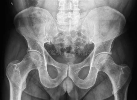 Male pelvis X-Ray stock image. Image of radiology, medical - 10049583