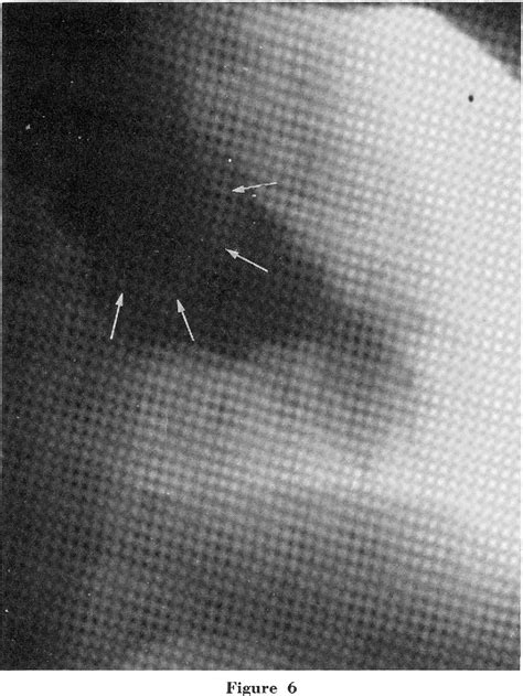 Figure 1 From Angiographic Appearance Of Idiopathic Hypertrophic