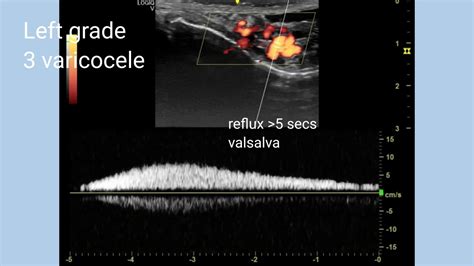 Varicocele Grade 3 Doppler Ultrasound Video Youtube