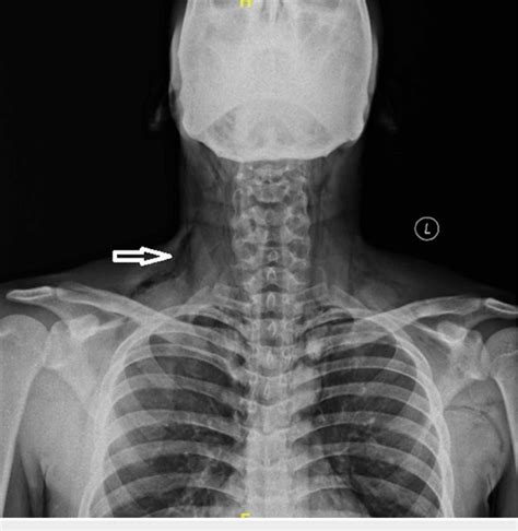 X Ray Neck Showing Subcutaneous Emphysema Arrow Download Scientific Diagram