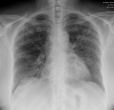 Usual Interstitial Pneumonia Uip Lungs