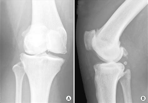 Osteophytes Knee