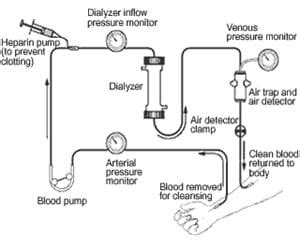 Types of Dialysis | Treatments & Procedures