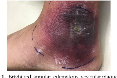 Figure From Vesiculobullous Lyme Disease A Case Series Semantic