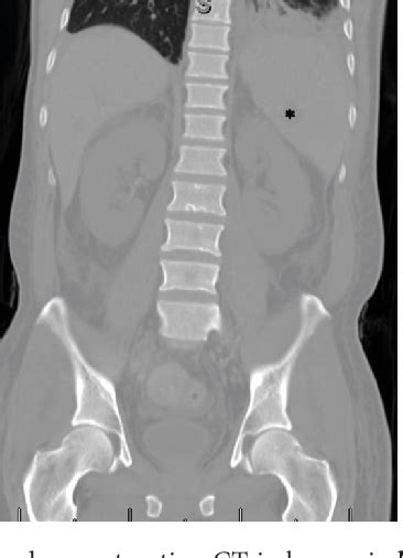 Figure From Progressive Diffuse Osteonecrosis In A Patient With