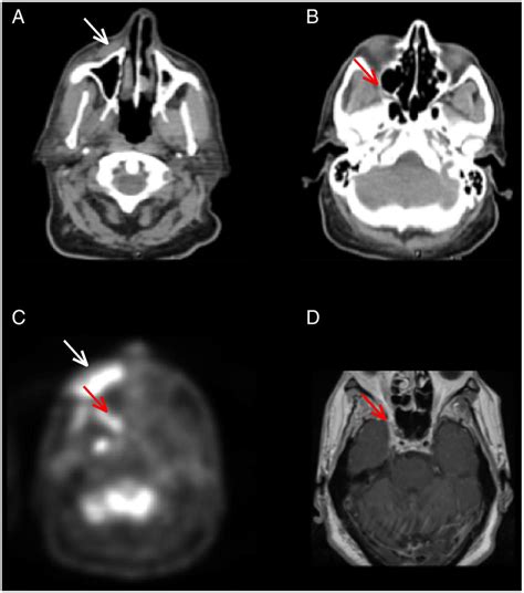 Radiographic Example Of Perineural Invasion Axial Computed Tomographic