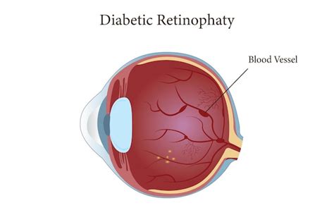 Premium Vector Illustration Of Diabetic Retinopathy In Human Eyes Eps 10