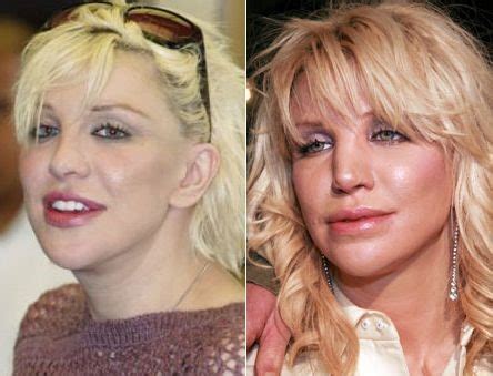 Courtney Love before and after plastic surgery – Celebrity plastic ...