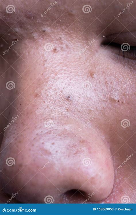 Ugly Pimples Blackheads On Nose Of Teenager Stock Image Image Of