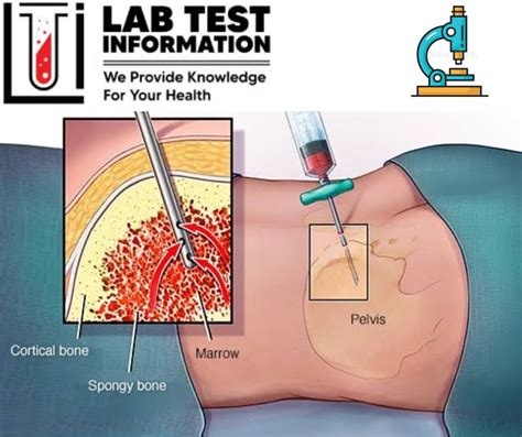 Bone Marrow Biopsy