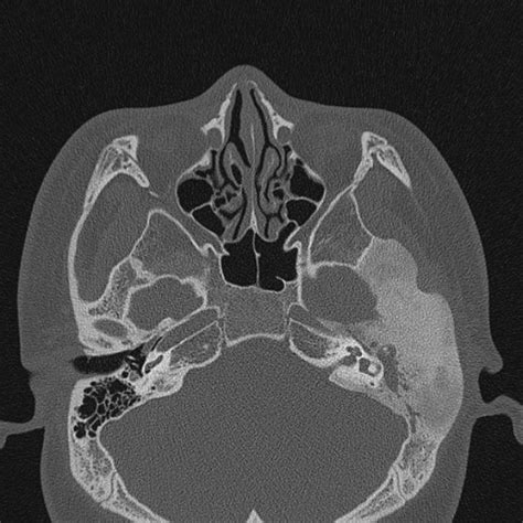 Fibrous Dysplasia Skull Base Radiology Case Radiology Skull Skull Anatomy