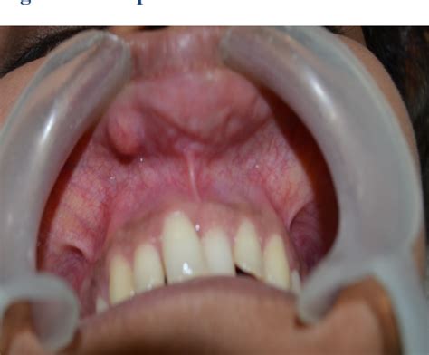 Figure I From 5 Pleomorphic Adenoma In A Minor Salivary Gland Of The