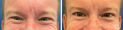 Crows Feet Botox Before And After Photos In Raleigh Blue Water Spa