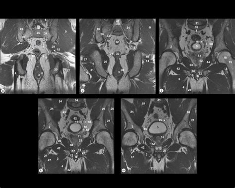 Male Pelvis Coronal Images Diagram Quizlet