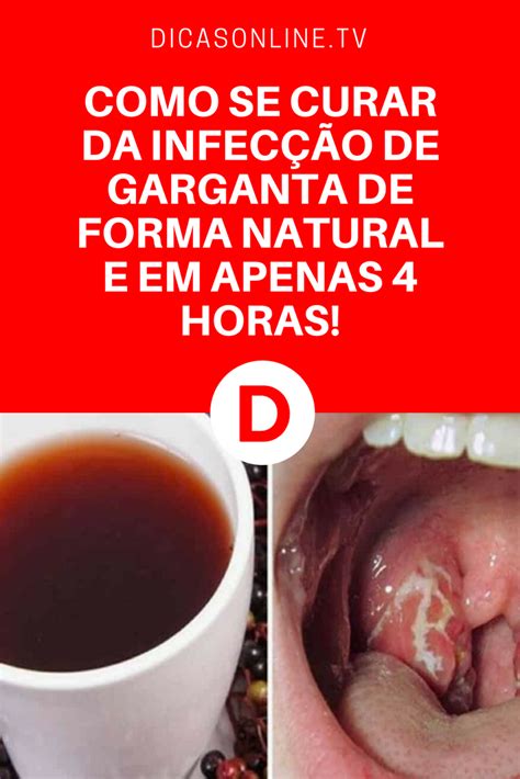 Garganta Inflamada Sintomas Causas E Como Tratar Hot Sex Picture