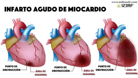 Infarto Fulminante Causas Y Síntomas Mdsaúde