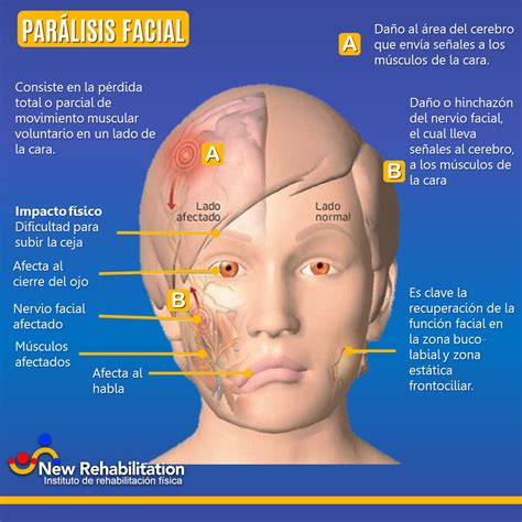 Parálisis facial sus diferentes tipos y cómo recuperarte