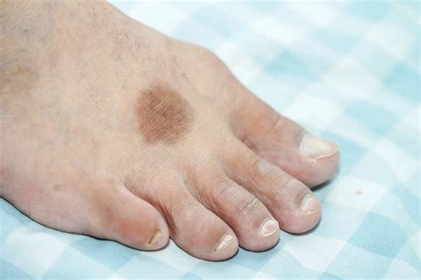 Identifying And Treating Rare Foot Conditions