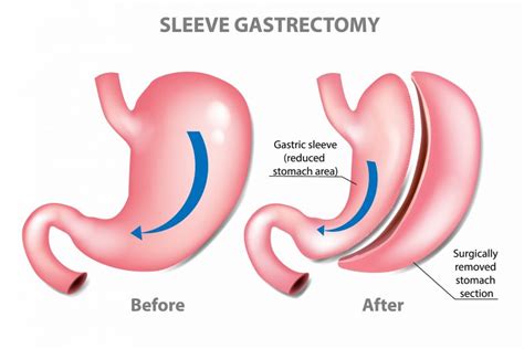 Gastric Sleeve Surgery St Louis MO Sleeve Gastrectomy