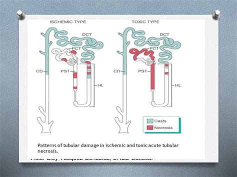 Necrosis Tubular Aguda PPT