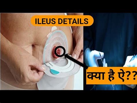 Understanding ILEUS YouTube