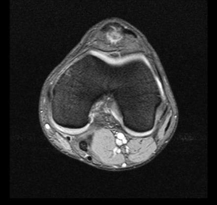 Sinding Larsen Johansson Disease Radiology Case Radiopaedia Org