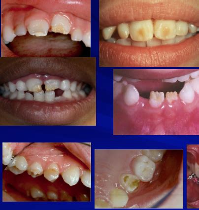 Oral Diseases Teeth Abnormalities Pt I Flashcards Quizlet