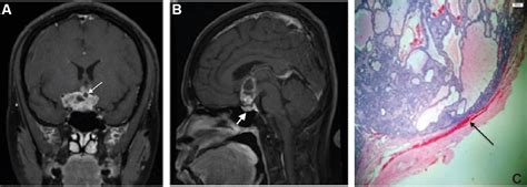 Craniopharyngioma And Pituitary Adenoma