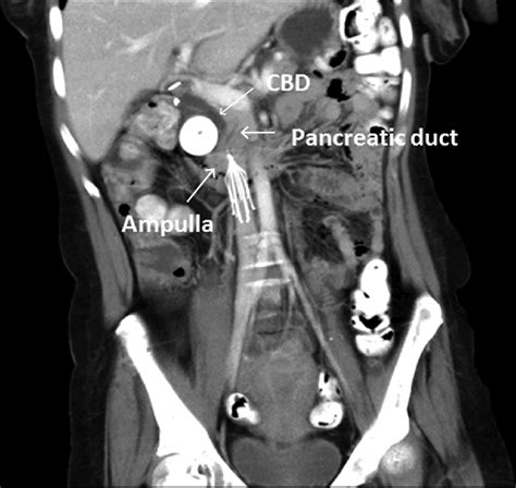 Interval Dilation Of The Common Bile Duct Cbd And Pancreatic Duct Download Scientific Diagram