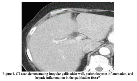 Emergency Medicine Educationacute Acalculous Cholecystitis In Adults Ed