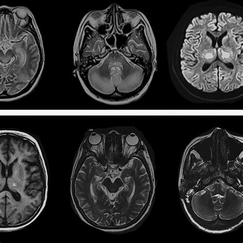 The Brain Mri Of Case 2 At Disease Onset A And After Treatment B A