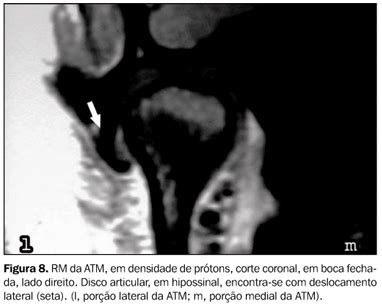 Radiologia Brasileira Articulação temporomandibular aspectos