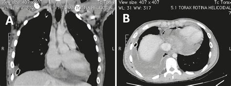 Scielo Brasil Pericardial Synovial Sarcoma Radiological Findings