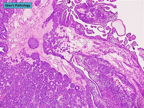 Qiao S Pathology Digital Papillary Carcinoma A Photo On Flickriver