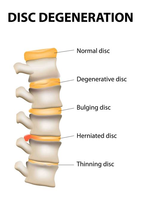 Slipped Disc Mabuhay Chiropractic Clinics