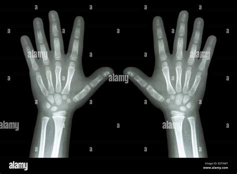 X Ray Both Child Hands On Black Background Stock Photo Alamy