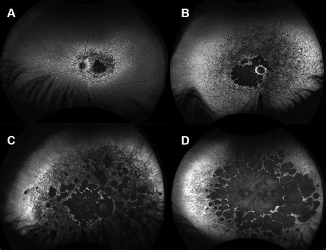 Cone Cone Rod Dystrophy For Professionals Gene Vision