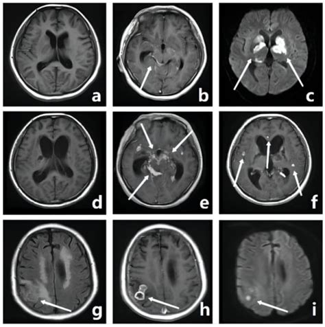 Diagnostics Free Full Text Cerebral Infarction And Evans Ratio On Mri Affect The Severity